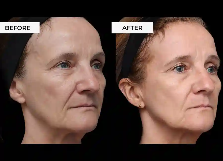 How Many RF Microneedling Sessions Will You Need to See a Difference Swindon?